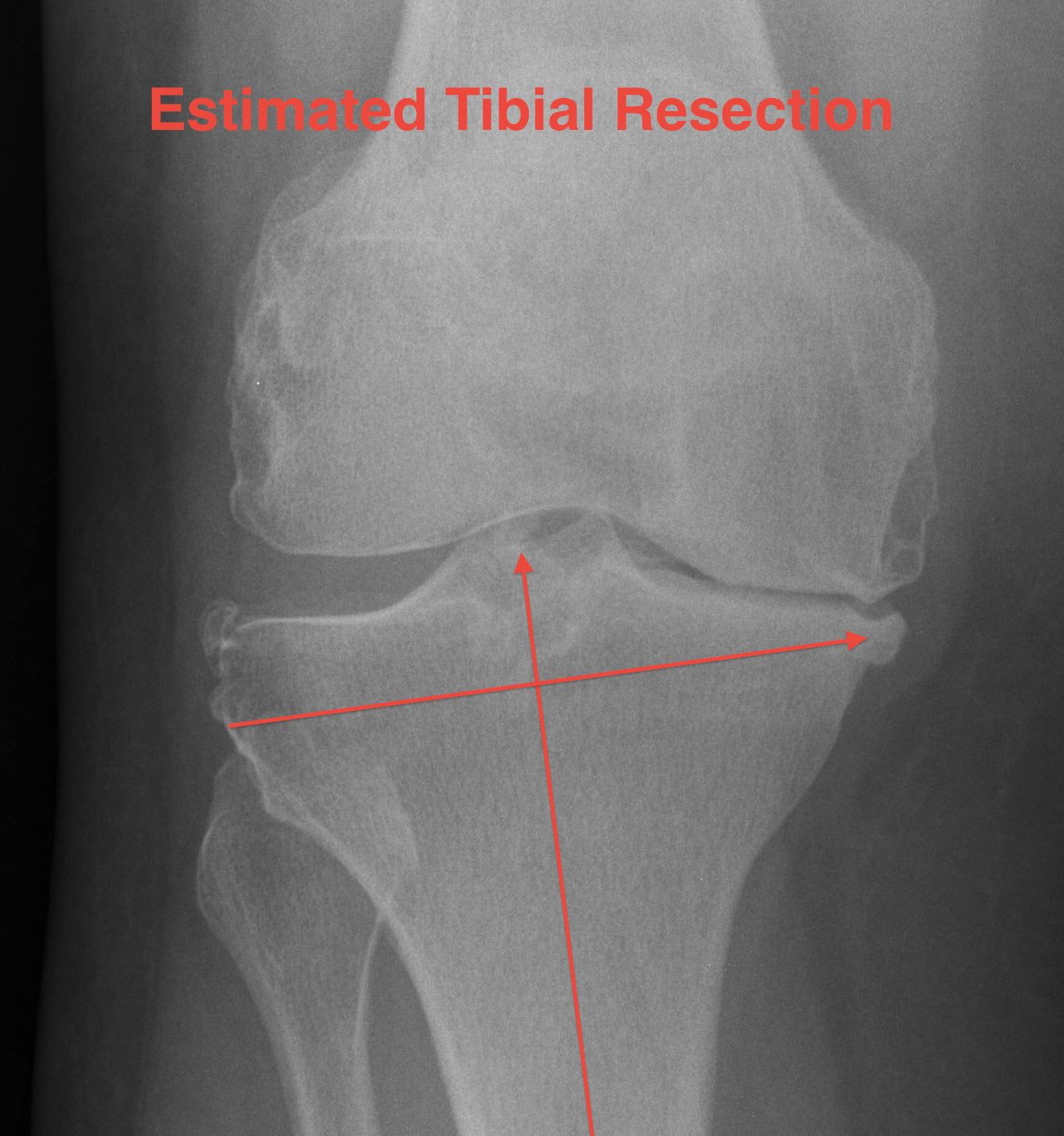 TKR Tibial Cut